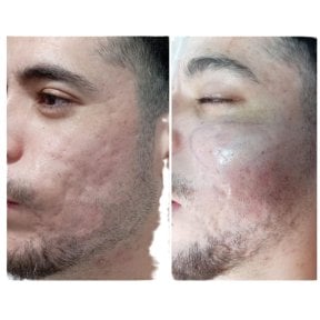 Before and after facial fat transfer at Hospital de la Familia, improved acne scar appearance result