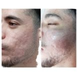 Before and after facial fat transfer at Hospital de la Familia, improved acne scar appearance result