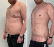 Before and after Vaser liposuction results at Dr. Safa Manav Clinic, improved body contour