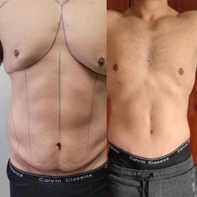Before and after Vaser liposuction results at Dr. Safa Manav Clinic, improved abdominal contour