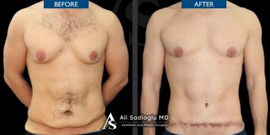 Before and after Vaser liposuction results at Dr. Safa Manav Clinic, improved male abdomen contour