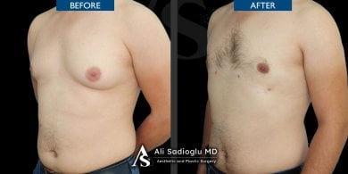 Before and after Vaser liposuction results at Dr. Safa Manav Clinic, male chest contouring