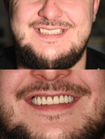 نتائج قبل وبعد زراعة أسنان All-on-6 في يوم واحد في Unident Clinic، ابتسامة مستعادة