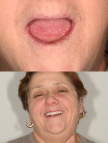 Результаты до и после установки скуловых All-on-4 имплантов в Unident Clinic, восстановленная улыбка