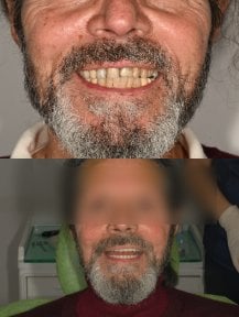 Результат до и после установки скуловых All-on-4 имплантов в Unident Clinic, улучшенная улыбка