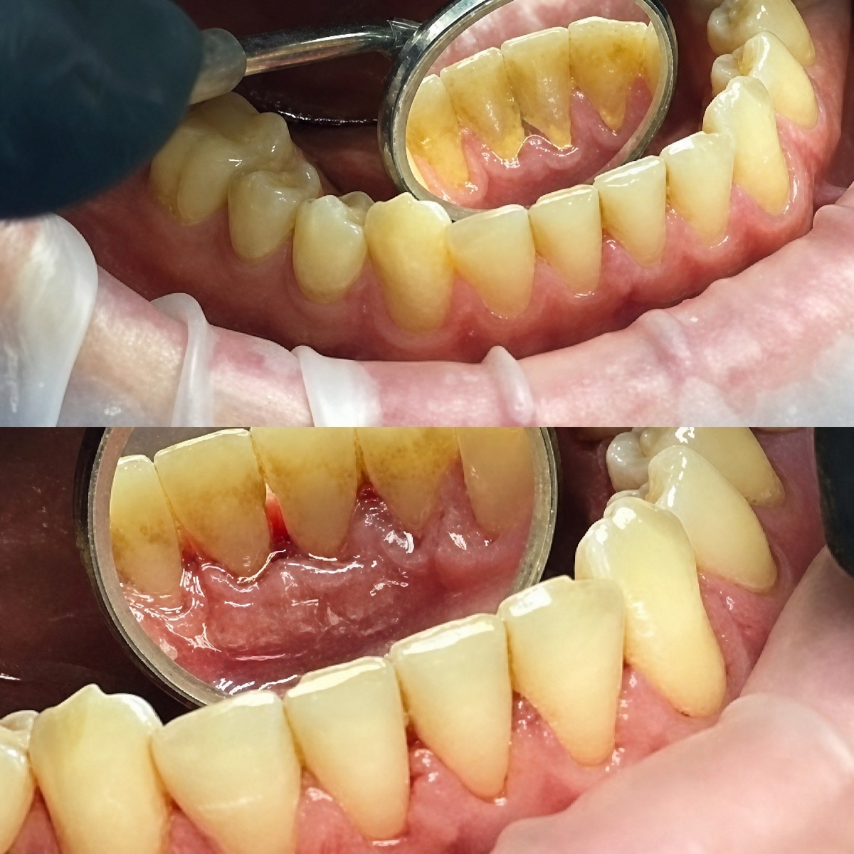 نتائج قبل وبعد تنظيف عميق (تقشير وتنعيم الجذور) في Casa Dental, s.r.o.