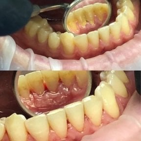 Resultados antes y después de limpieza profunda (raspado y alisado radicular) en Casa Dental, s.r.o.