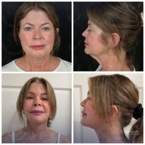 Vorher-nachher-Ergebnisse Facelift bei Dr. Safa Manav Clinic, sichtbare Verjüngung