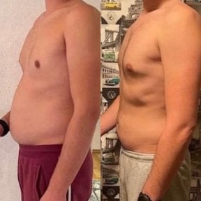 Before and after Vaser liposuction results at Dr. Safa Manav Clinic, improved abdominal contour