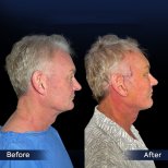Vorher-nachher-Ergebnis Deep Plane Facelift bei Dr. Safa Manav Clinic, sichtbare Verjüngung
