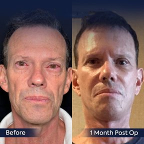 Vorher-nachher-Ergebnis Deep Plane Facelift bei Dr. Safa Manav Clinic, 1 Monat post-op