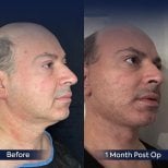 Vorher-nachher-Ergebnis Deep Plane Facelift bei Dr. Safa Manav Clinic, sichtbare Verjüngung