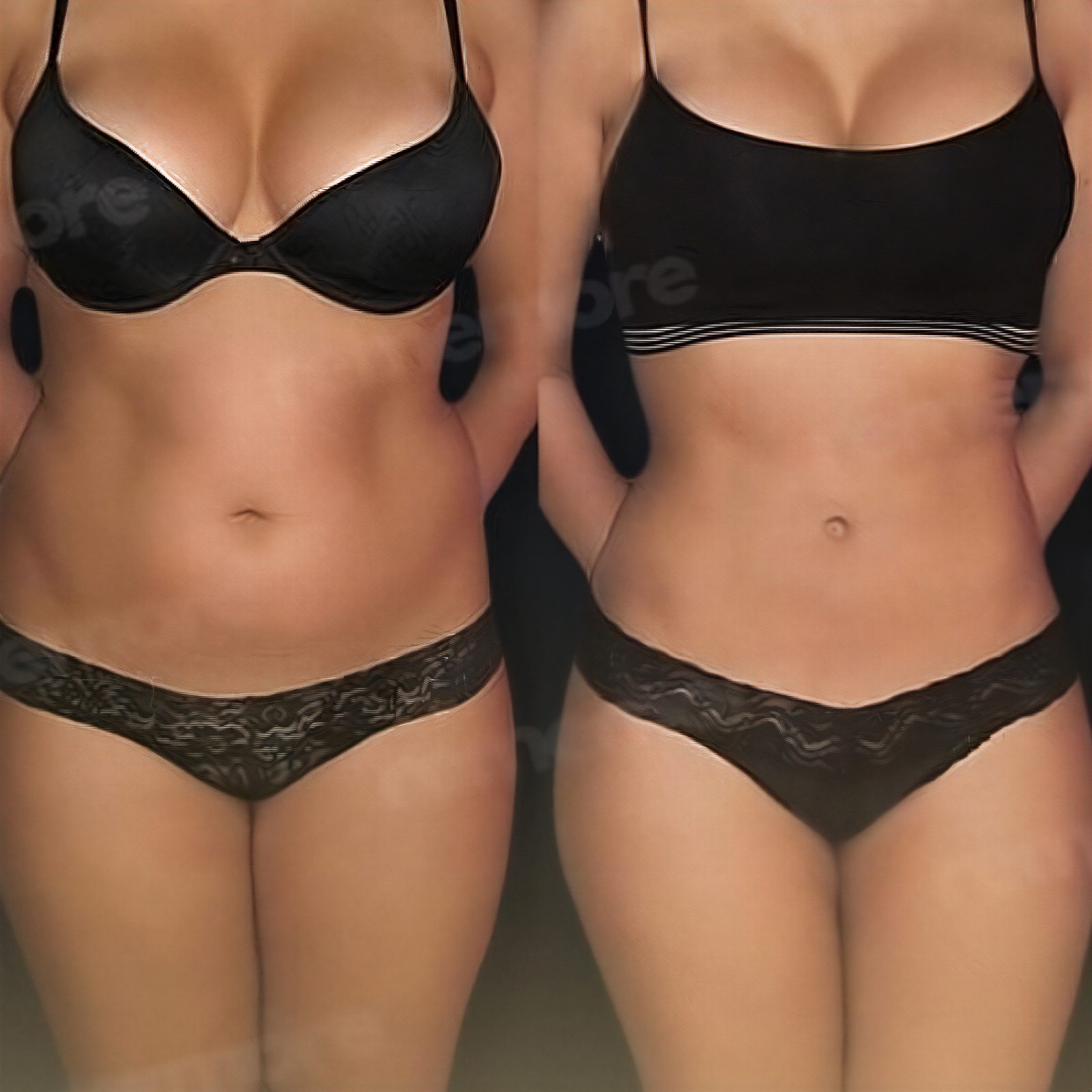 Resultados de abdominoplastia antes y después en Memorial Ankara Hospital, contorno visible