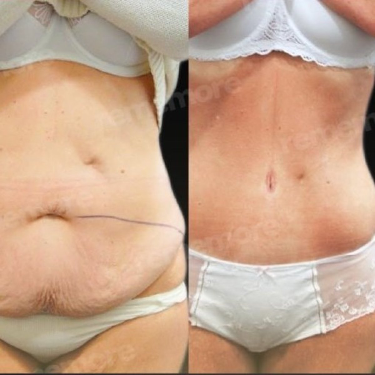 Resultados antes y después de abdominoplastia Fleur De Lis en Memorial Bahçelievler Hospital, abdomen plano