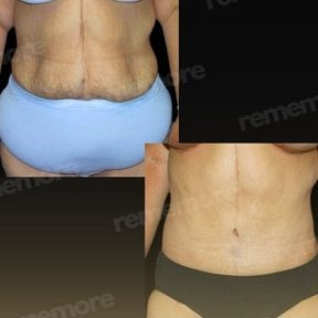 Before and after Fleur De Lis tummy tuck results at Memorial Bahçelievler Hospital, abdomen contour