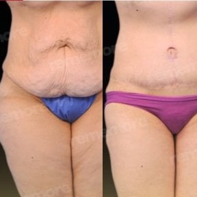 Before and after Fleur De Lis tummy tuck results at Memorial Bahçelievler Hospital, abdomen contour