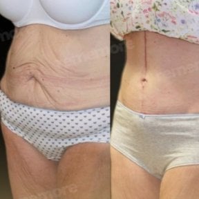 Before and after Fleur De Lis tummy tuck results at Memorial Bahçelievler Hospital, abdomen contour