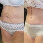 Before and after Fleur De Lis tummy tuck results at Memorial Bahçelievler Hospital, abdomen contour