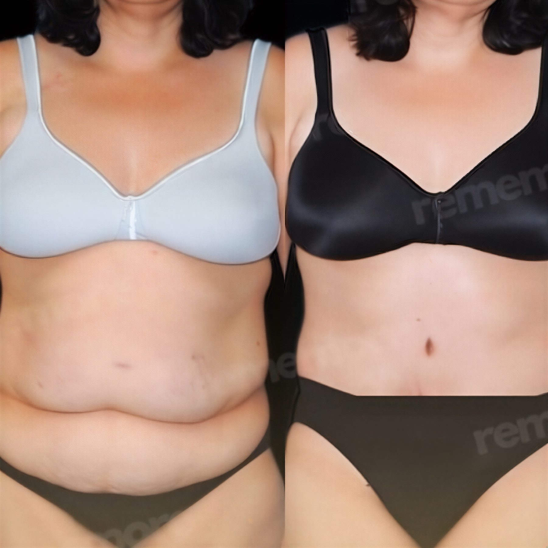 Resultados antes y después de abdominoplastia Fleur De Lis en Memorial Bahçelievler Hospital, abdomen