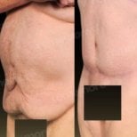 Before and after Fleur De Lis tummy tuck results at Memorial Bahçelievler Hospital, abdomen contour