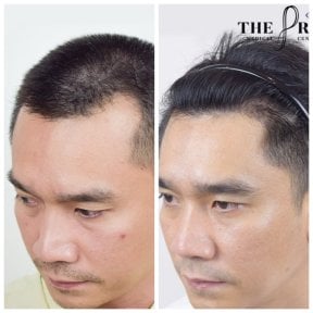 Результати пересадки волосся до і після в Department of Hair, Aesthetics & Surgery @ Navamin 9 Hospital