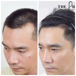 Результати пересадки волосся до і після в Department of Hair, Aesthetics & Surgery @ Navamin 9 Hospital