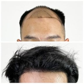 Результати до і після пересадки волосся в Department of Hair, Aesthetics & Surgery @ Navamin 9 Hospital