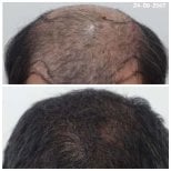 Before and after hair transplant results at Department of Hair, Aesthetics & Surgery @ Navamin 9 Hospital