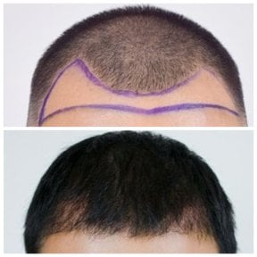 Before and after hair transplant results at Department of Hair, Aesthetics & Surgery @ Navamin 9 Hospital