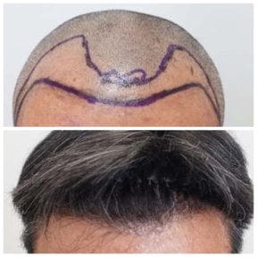 Before and after hair transplant results at Department of Hair, Aesthetics & Surgery @ Navamin 9 Hospital