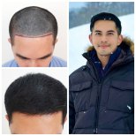 Результати пересадки волосся до і після в Department of Hair, Aesthetics & Surgery @ Navamin 9 Hospital
