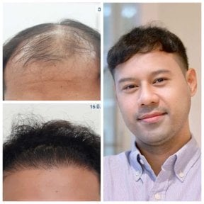 Before and after hair transplant results at Department of Hair, Aesthetics & Surgery @ Navamin 9 Hospital