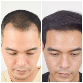 Before and after hair transplant results at Department of Hair, Aesthetics & Surgery @ Navamin 9 Hospital