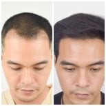 Before and after hair transplant results at Department of Hair, Aesthetics & Surgery @ Navamin 9 Hospital