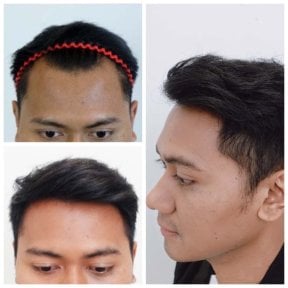 Before and after hair transplant results at Department of Hair, Aesthetics & Surgery @ Navamin 9 Hospital