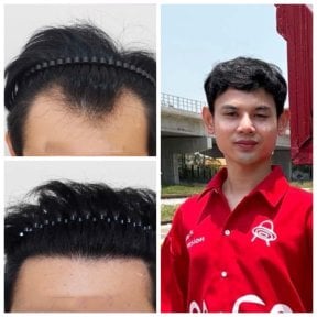 Before and after hair transplant results at Department of Hair, Aesthetics & Surgery @ Navamin 9 Hospital