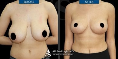 Before and after breast reduction results at Dr. Safa Manav Clinic, improved breast contour