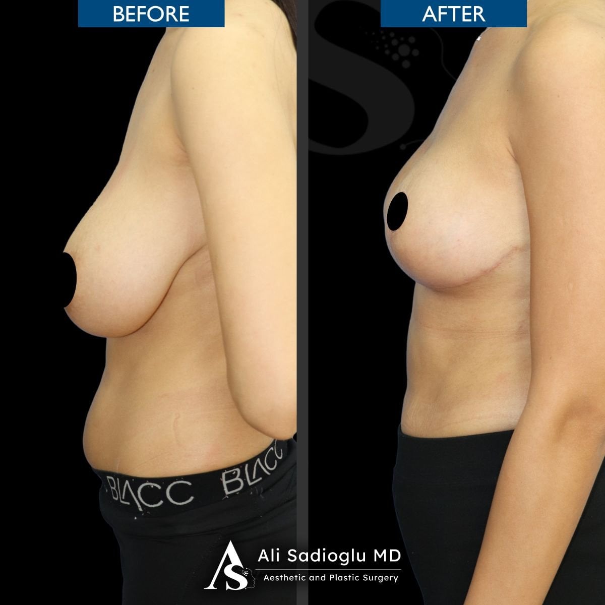 Resultados antes y después de reducción de senos en Dr. Safa Manav Clinic, mejor contorno