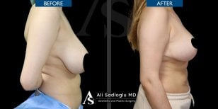 Before and after breast reduction results at Dr. Safa Manav Clinic, improved breast contour