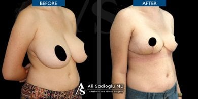 Before and after breast reduction results at Dr. Safa Manav Clinic, improved breast contour
