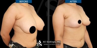 Before and after breast reduction results at Dr. Safa Manav Clinic, improved breast contour