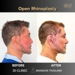 Before and after open rhinoplasty results at ID Clinic Bangkok, nose reshaping for men