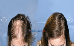 نتائج زراعة الشعر قبل وبعد في CE International Hospital، كثافة شعر محسنة