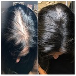 نتائج زراعة الشعر قبل وبعد في CE International Hospital، كثافة شعر محسنة
