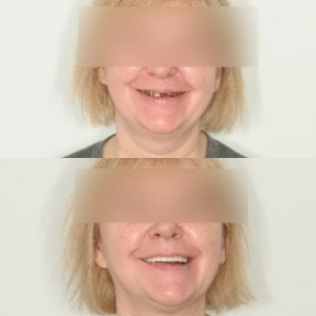 Vorher-nachher-Ergebnis All-on-4 Zahnimplantate an einem Tag bei Unident Clinic, Lächeln erneuert