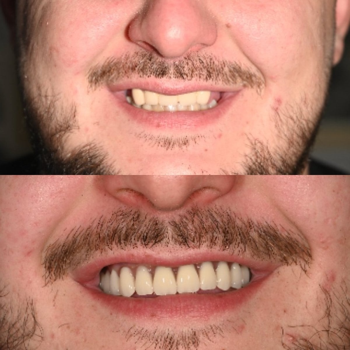 نتائج قبل وبعد زراعة أسنان All-on-6 في يوم واحد في Unident Clinic، ابتسامة محسنة