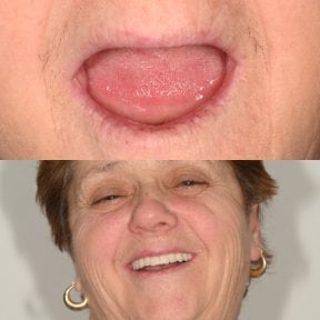 Результат до та після установки скулових All-on-4 імплантів в Unident Clinic, відновлена посмішка