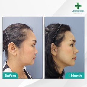 Before and after Deep Plane Facelift results at Intrarat Hospital – visible facial contour lift