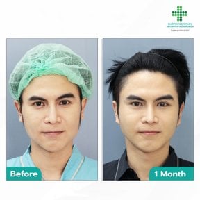 Before and after deep plane facelift results at Intrarat Hospital, visible facial rejuvenation