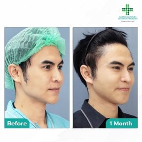 Before and after deep plane facelift results at Intrarat Hospital, visible facial contour improvement